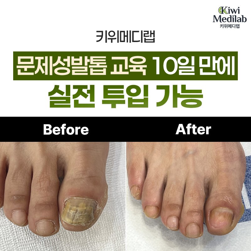 외과 내성발톱 비급여 치료 교육 추천